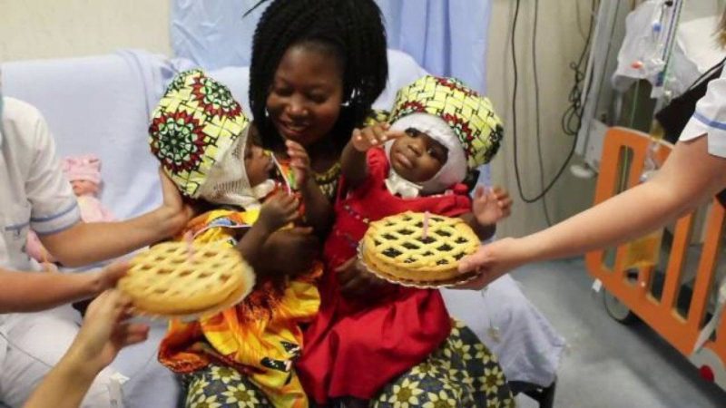 gemelle siamesi divise